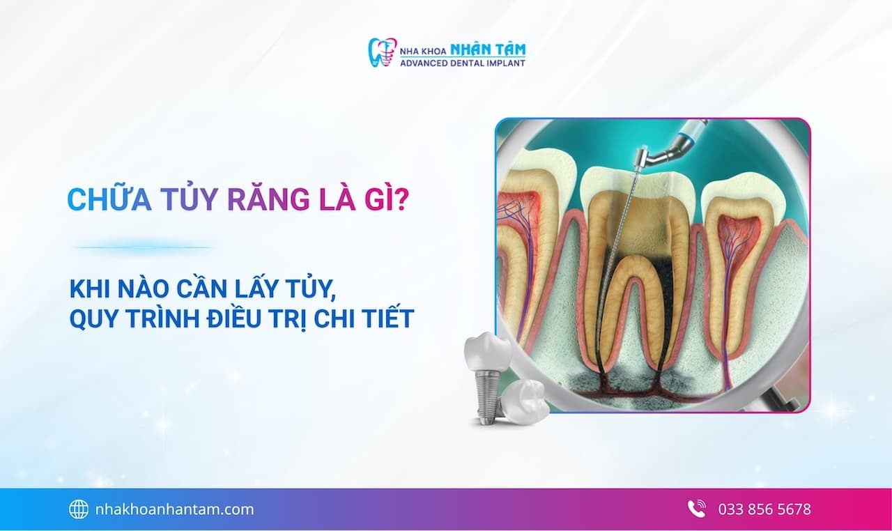 Chữa tủy răng là gì? Khi nào cần lấy tủy và quy trình điều trị chi tiết 